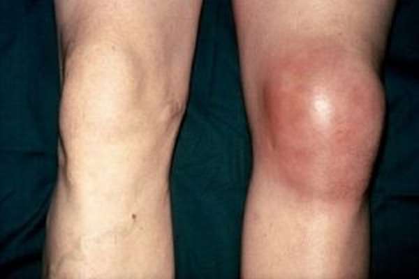 Лечение суставных болей в колене